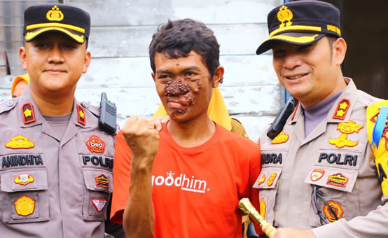 Peduli Warga, Kapolres Bengkalis Bantu Penderita Penyakit Kanker Kulit Berobat ke Rumah Sakit